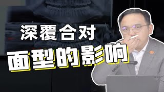 牙齿矫正 | 深覆合会对面型产生什么影响呢？