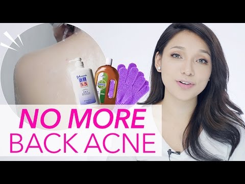 Get Rid of Back Acne/Pimple (in ONE WEEK)| GDiipa Get Rid of Back Acne/Pimple (in ONE WEEK)| GDiipa