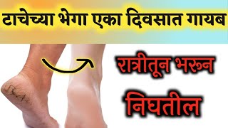 टाचेच्या भेगा घरगुती उपाय|cracked heels, tachechya bhega upay|Home Remedy for Cracked Heels