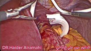 حلقة المعدة بالروبوت د حيدر الرماحي gastric band with robot artesential Dr.haider  alramahi