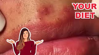 Why you have Blackhead on your lip (And how to stop them)