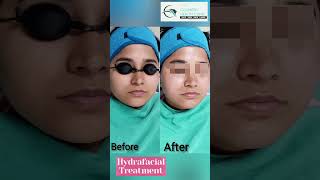 ✨ Get that HydraFacial Glow ✨Say goodbye to dull skin and hello to a radiant complexion! 🌟