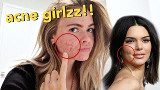 I went to Kendall Jenner's dermatologist to save my skin *acne struggles* | Summer Mckeen