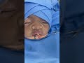 rare cute cleft lip baby before operation and after dr sunil richardson