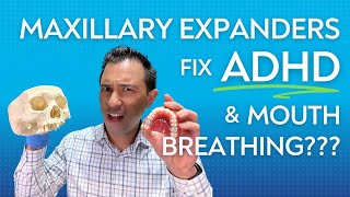 Can Maxillary Expanders Fix ADHD And Mouth Breathing? For Real ...