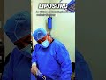 tecnologia del liposurg