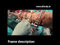 ilizarov surgical technique infected tibia fracture non union dr shamsul hoda ilizarov lecture