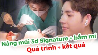 Bác Sĩ Huy Giải Đáp Nâng Mũi 3D Signature Kết Hợp Bấm Mí – Kết Quả Ngay Trong Phòng Mổ