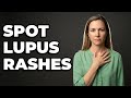How To Spot Subacute Cutaneous Lupus Rashes?