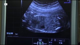 IU Health prepares for abortion law changes