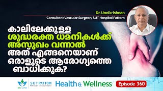 കാലിലേക്കുള്ള ശുദ്ധരക്ത ധമനികൾക്ക്‌ അസുഖം വന്നാലത്‌ എങ്ങനെയാണ്‌ ഒരാളുടെ ആരോഗ്യത്തെ ബാധിക്കുക? Ep 360