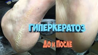 Педикюр . Обработка стопы (гиперкератоз)