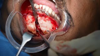 Road Traffic Accident Fracture on Lower Mandible - Subchondral Fracture