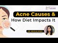 Acne Causes & How Diet Impacts It | Dr. Megha Modi | Dermatologist