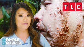 Strangest Skin Conditions | Dr. Pimple Popper | TLC