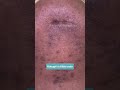 COMPLICATED SCAR REVISION - DR. TANVEER JANJUA- NEW JERSEY