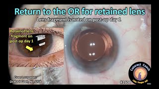 CataractCoach 1604: return to the OR for retained lens fragment