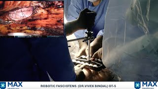 Robotic eTEP RS with Fasciotens for recurrent incisional hernia