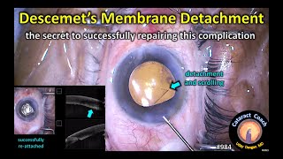 Descemet's Membrane Detachment during Cataract Surgery