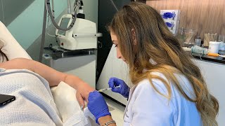 Hand Rejuvenation using Fillers | West Hollywood, CA | Dr. Jason Emer