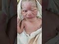 Strange looking Newborn baby after birth due to face presentation #baby #shorts #shortvideo