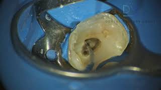 Endodontic irrigation  tips