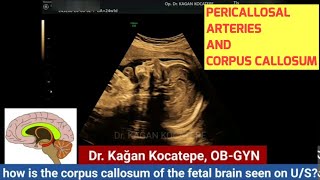 Fetal corpus callosum:function and detection of pericallosal arteries with the help of Color Doppler