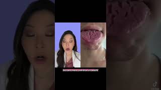 HUGE cracks in tongue! #fissuredrongue #tongue #denrist