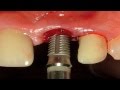 Sargon Dental Implants, Same Day Dental Implants, Tooth with Apical Lesion