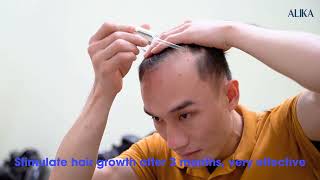 Customers improve thin, weak and bald hair U-shaped by ALIKA