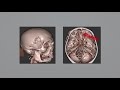 mini pterional approach for clip ligation of ethmoidal dural arteriovenous fistula