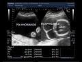 Ultrasound Video showing Fetus with Polyhydromnios and Encephalocele.