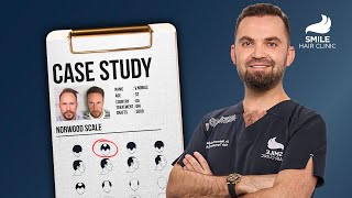 Case Study with Dr. Mehmet Erdogan | 5000 Grafts | 12-Month Transformation - Hair Transplant