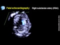 Fetal echocardiography at 11-13 weeks of pregnancy