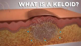 WHAT IS A KELOID?