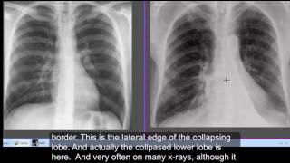 Chest  x-ray,  Left lower lobe collapse - CT chest lower lobe collapse