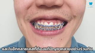 ยางดึงฟัน || ทุกสิ่งต้องรู้เกี่ยวกับยางดึงฟัน ครบจบใน 3 นาที