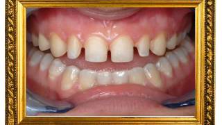 Empress Aesthetic or Emax Porcelain Veneers