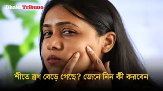 শীতে ব্রণ বেড়ে গেছে? জেনে নিন কী করবেন | Dhaka Tribune