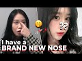 [SUB] Nose Job Review vlog | Experience, Before After | Rhinoplasty Korea Plastic Surgery Hospital