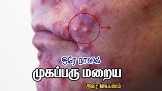 மூக பரு மறைய ஒரு சிறந்த வழி|get rid of pimples naturally