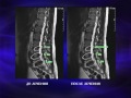 Успешное безоперационное лечение межпозвонковой грыжи у Елены