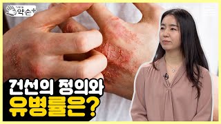 건선의 정의와 유병률 [오해와 편견이 많은 피부질환 ‘건선’ 바로 알기 ①] | 메디컬 약손