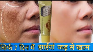 My Fair Cream Complete Review| हिन्दी मैं |My Fair Cream Remove Pigmentation|Melasma And Scars|