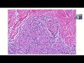 tuberculoid leprosy definition causes gross and histological characteristics