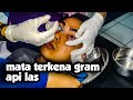 mata terkena GRAM - percikan besi las