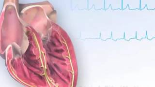 American Heart Association (AHA) Atrial Fibrillation Animation