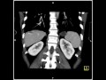 Abdomen: Liver: Hemangioma of the Liver(7 of 8)