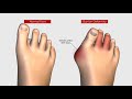 Lapiplasty - 3D Bunion Correction