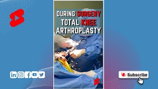 Total Knee Arthroplasty 🪚 #shorts #bonecuts #orthopedics